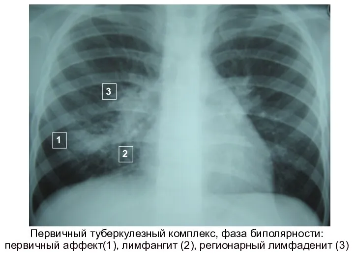 Первичный туберкулезный комплекс, фаза биполярности: первичный аффект(1), лимфангит (2), регионарный лимфаденит (3) 1 2 3