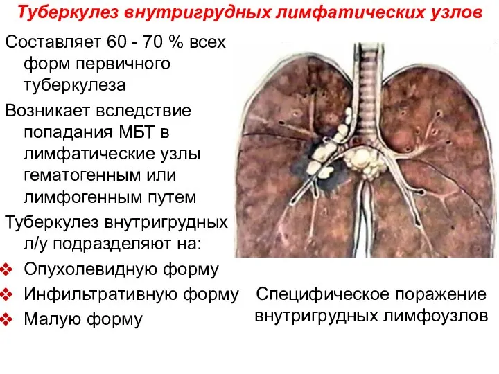 Туберкулез внутригрудных лимфатических узлов Составляет 60 - 70 % всех форм