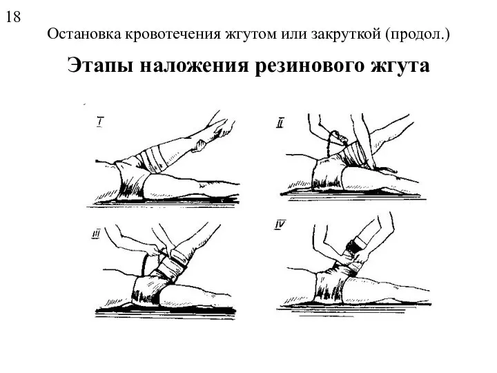 Остановка кровотечения жгутом или закруткой (продол.) Этапы наложения резинового жгута 18