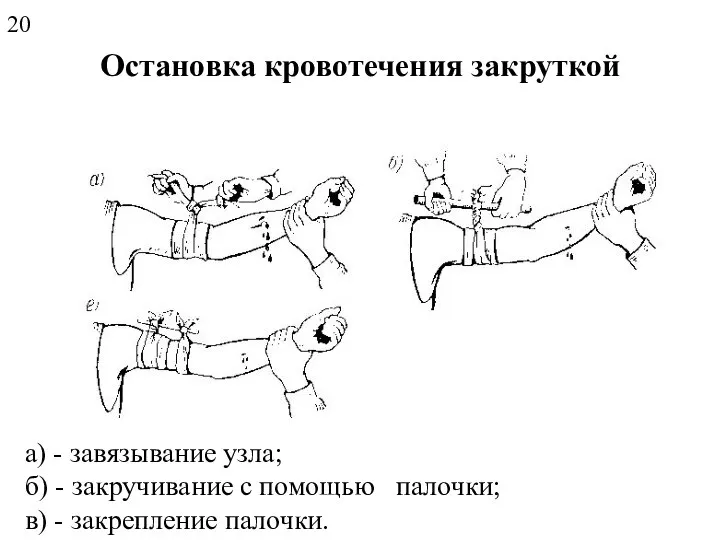 Остановка кровотечения закруткой а) - завязывание узла; б) - закручивание с