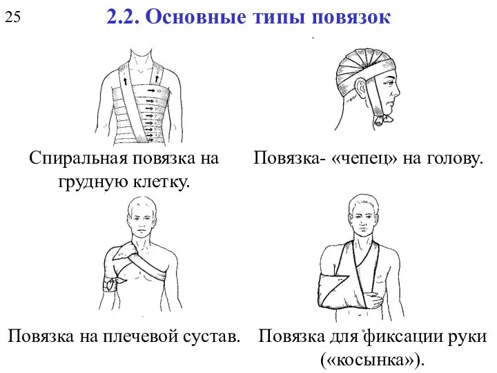 2.2. Основные типы повязок Спиральная повязка на грудную клетку. Повязка- «чепец»