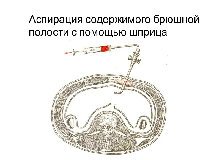 Аспирация содержимого брюшной полости с помощью шприца