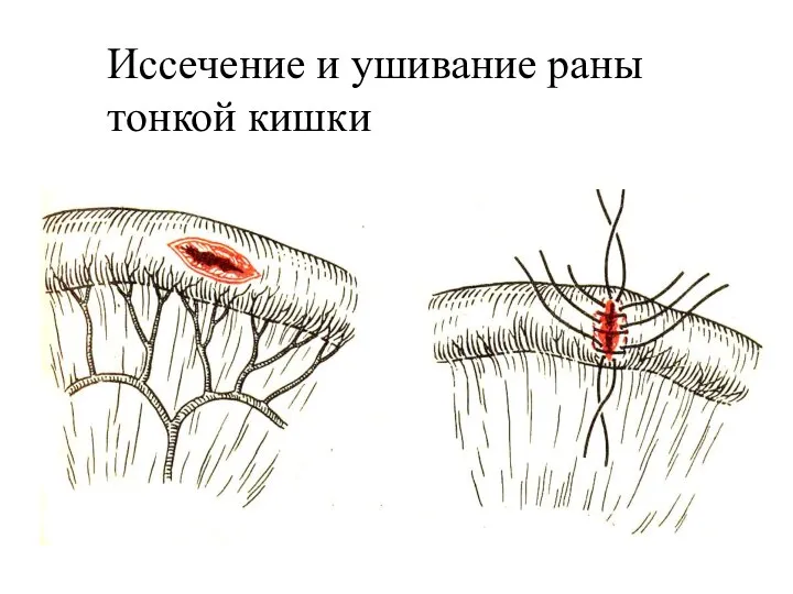 Иссечение и ушивание раны тонкой кишки