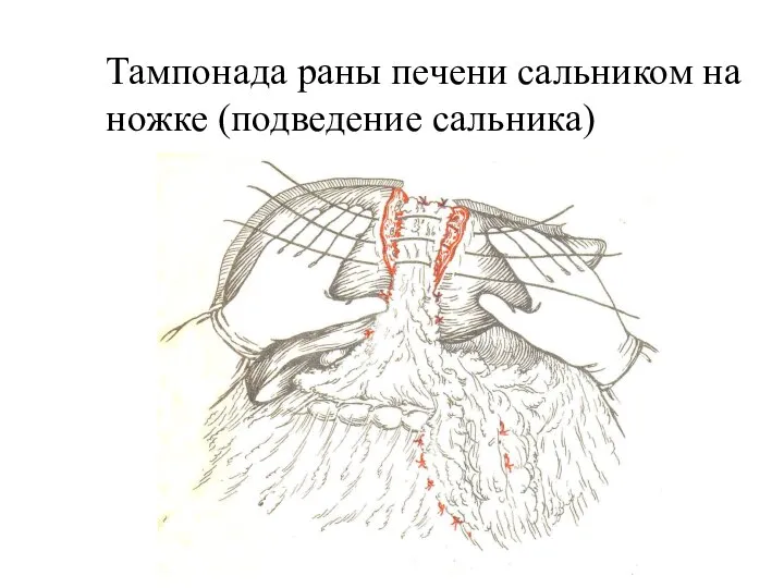 Тампонада раны печени сальником на ножке (подведение сальника)