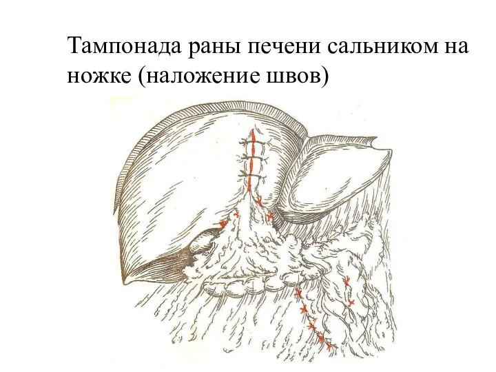 Тампонада раны печени сальником на ножке (наложение швов)