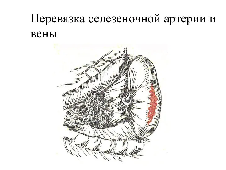 Перевязка селезеночной артерии и вены