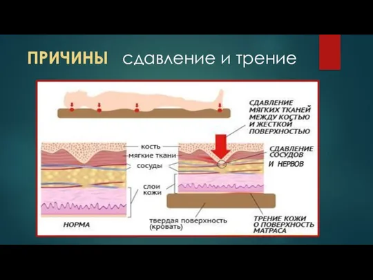 ПРИЧИНЫ сдавление и трение И НЕРВОВ