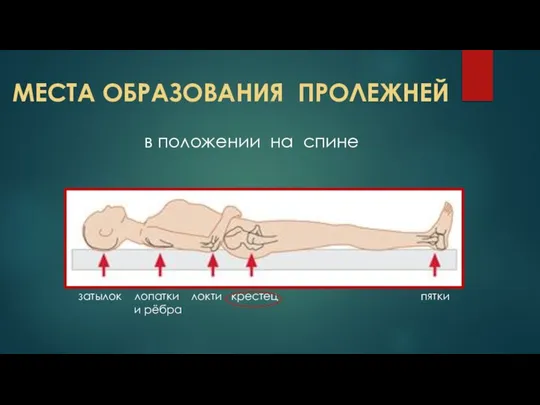 МЕСТА ОБРАЗОВАНИЯ ПРОЛЕЖНЕЙ в положении на спине затылок лопатки локти крестец пятки и рёбра