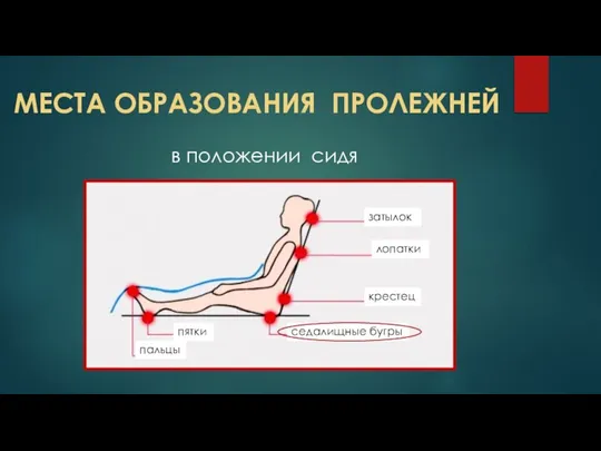 МЕСТА ОБРАЗОВАНИЯ ПРОЛЕЖНЕЙ в положении сидя лопатки затылок крестец седалищные бугры пятки пальцы