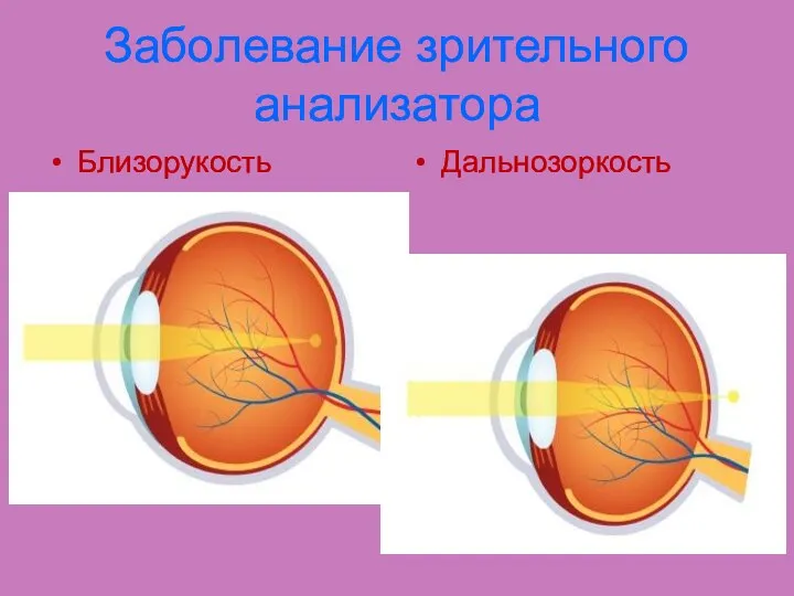 Заболевание зрительного анализатора Близорукость Дальнозоркость