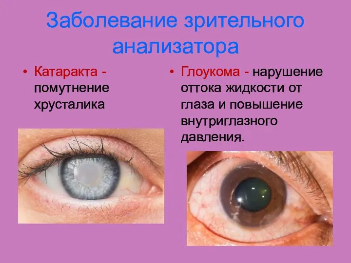 Заболевание зрительного анализатора Катаракта - помутнение хрусталика Глоукома - нарушение оттока
