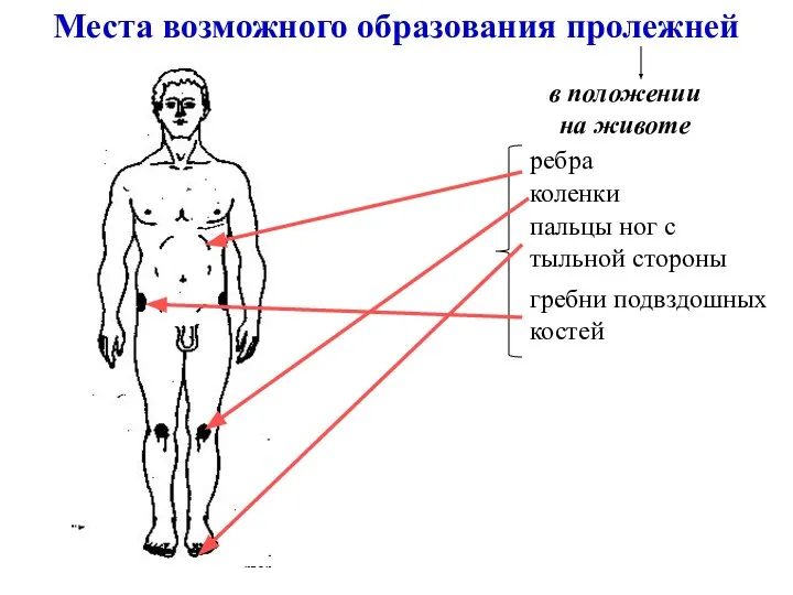 Места возможного образования пролежней в положении на животе ребра коленки пальцы