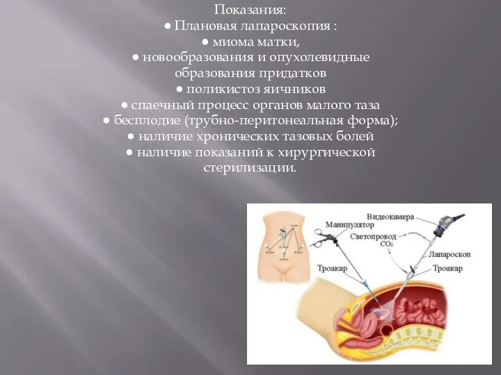 Показания: ● Плановая лапароскопия : ● миома матки, ● новообразования и