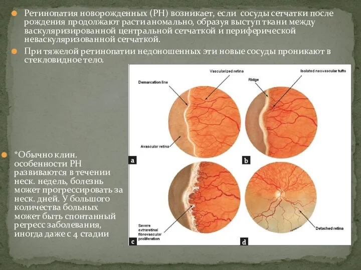 Ретинопатия новорожденных (РН) возникает, если сосуды сетчатки после рождения продолжают расти