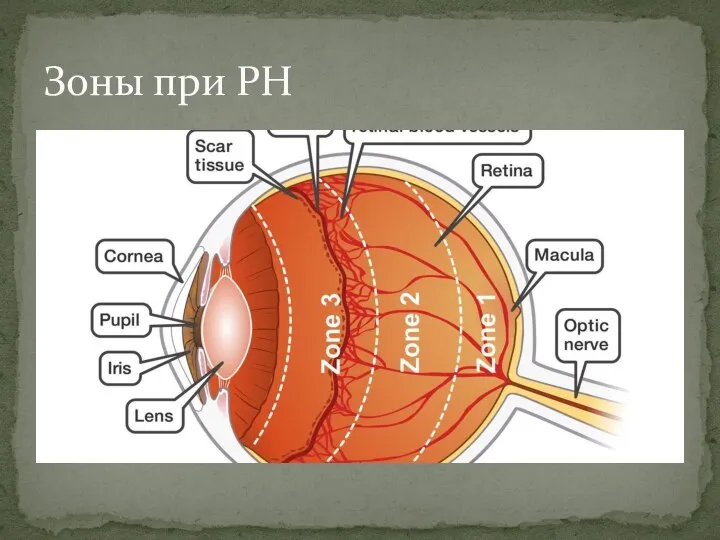 Зоны при РН