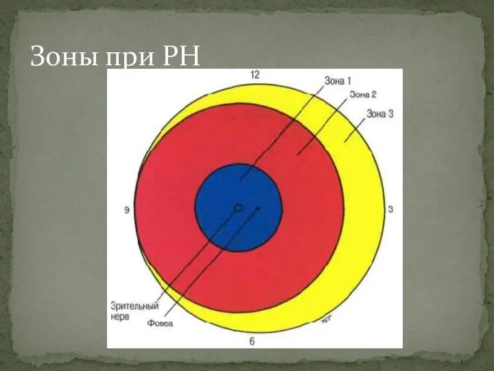 Зоны при РН