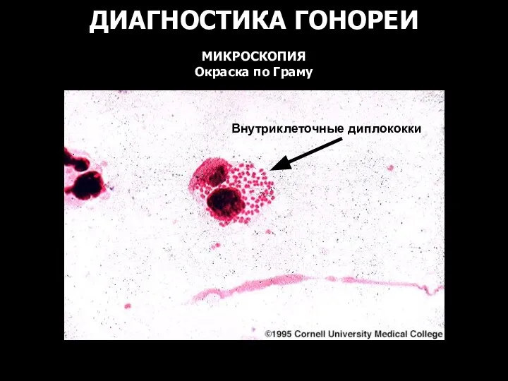 ДИАГНОСТИКА ГОНОРЕИ МИКРОСКОПИЯ Окраска по Граму Внутриклеточные диплококки