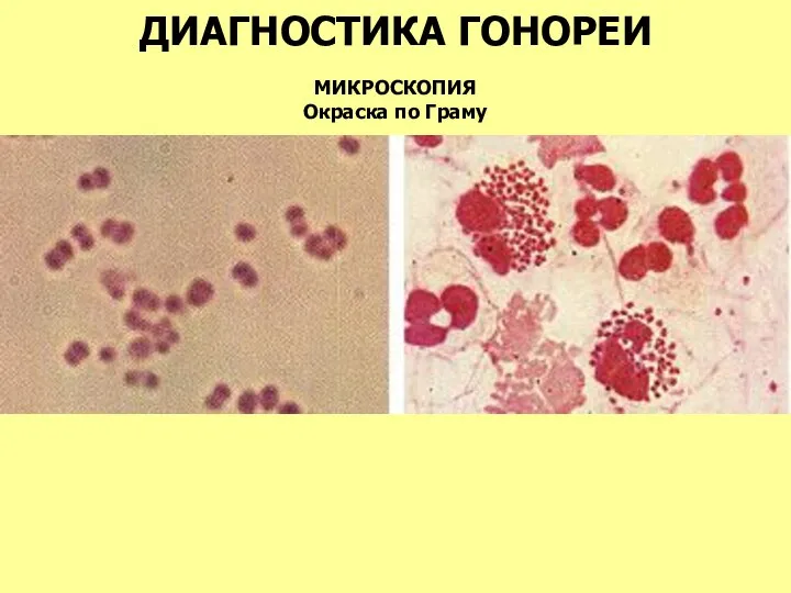 ДИАГНОСТИКА ГОНОРЕИ МИКРОСКОПИЯ Окраска по Граму