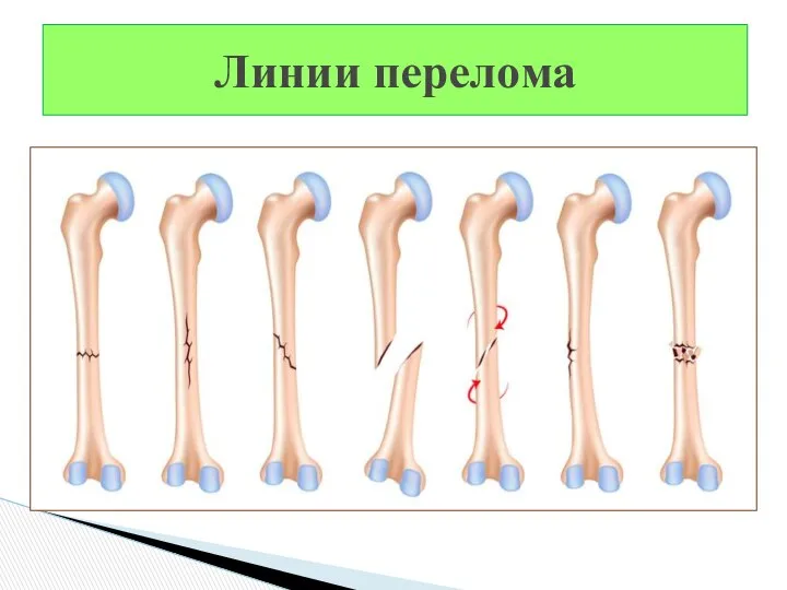 Линии перелома