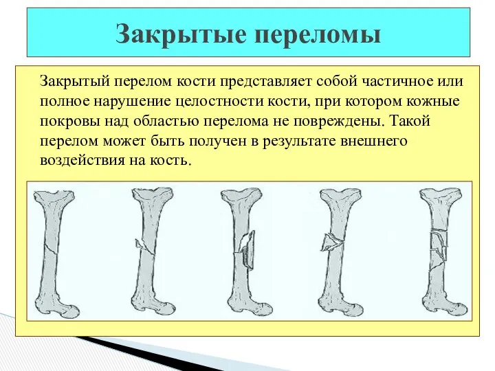 Закрытый перелом кости представляет собой частичное или полное нарушение целостности кости,