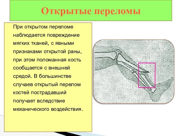 При открытом переломе наблюдается повреждение мягких тканей, с явными признаками открытой