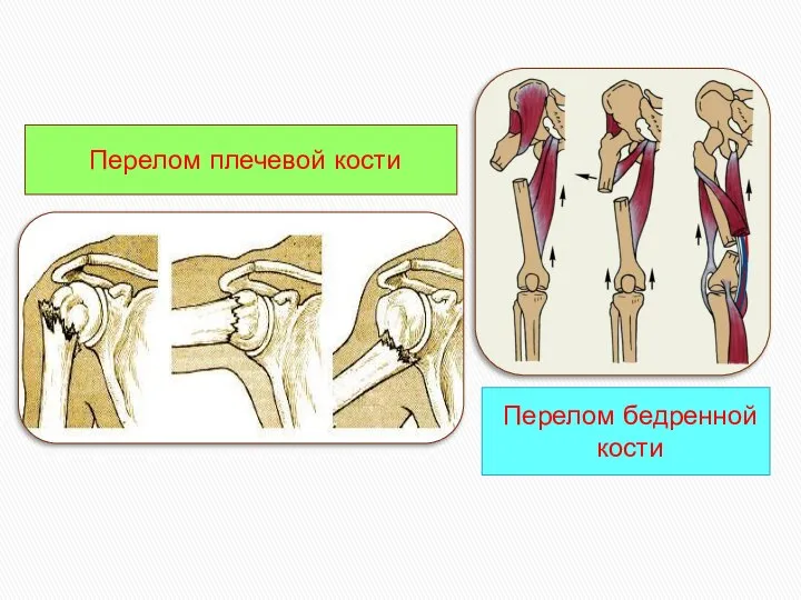 Перелом плечевой кости Перелом бедренной кости