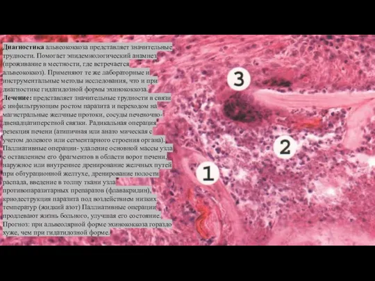 Диагностика альвеококкоза представляет значительные трудности. Помогает эпидемиологический анамнез (проживание в мест­ности,