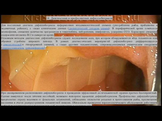 14. Диагностика и профилактика дифиллоботриоза Для постановки диагноза дифиллоботриоза информативен эпидемиологический