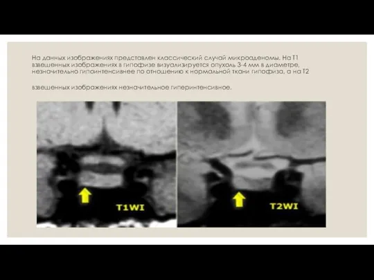 На данных изображениях представлен классический случай микроаденомы. На Т1 взвешенных изображениях