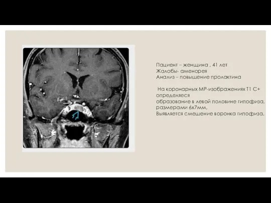 Пациент – женщина , 41 лет Жалобы- аменорея Анализ – повышение