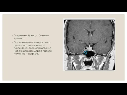 Пациентка 36 лет , с болезни Кушинга. После введении контрастного препарата