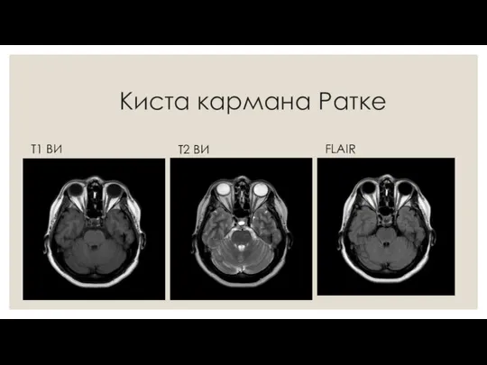 Киста кармана Ратке Т1 ВИ Т2 ВИ FLAIR