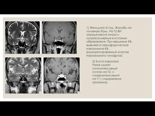 1) Женщина 61год. Жалобы на головную боль. На Т2 ВИ определяются