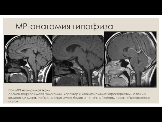 МР-анатомия гипофиза При МРТ нормальная ткань аденогипофиза имеет гомогенный характер и