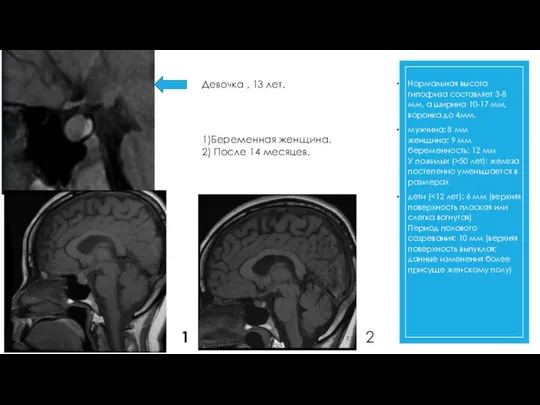 Размер гипофиза Нормальная высота гипофиза составляет 3-8 мм, а ширина 10-17