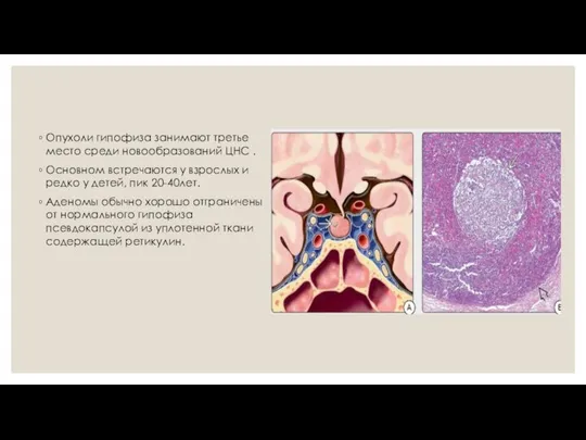 Опухоли гипофиза занимают третье место среди новообразований ЦНС . Основном встречаются