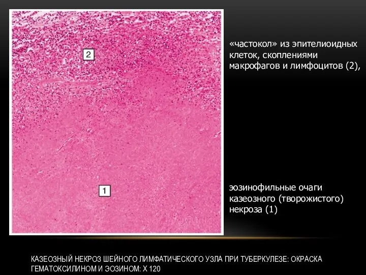 КАЗЕОЗНЫЙ НЕКРОЗ ШЕЙНОГО ЛИМФАТИЧЕСКОГО УЗЛА ПРИ ТУБЕРКУЛЕЗЕ: ОКРАСКА ГЕМАТОКСИЛИНОМ И ЭОЗИНОМ: