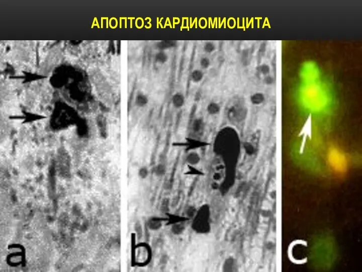 АПОПТОЗ КАРДИОМИОЦИТА