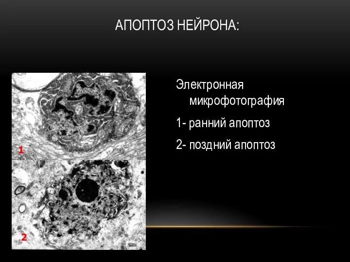 АПОПТОЗ НЕЙРОНА: Электронная микрофотография 1- ранний апоптоз 2- поздний апоптоз 1 2