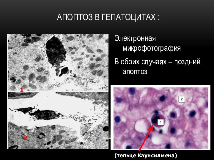 АПОПТОЗ В ГЕПАТОЦИТАХ : Электронная микрофотография В обоих случаях – поздний апоптоз 2 1 (тельце Каунсилмена)