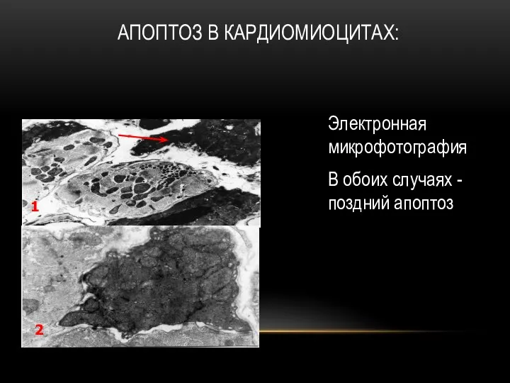 АПОПТОЗ В КАРДИОМИОЦИТАХ: Электронная микрофотография В обоих случаях - поздний апоптоз 1 2