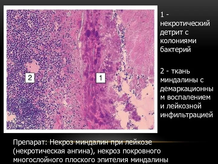 Препарат: Некроз миндалин при лейкозе (некротическая ангина), некроз покровного многослойного плоского