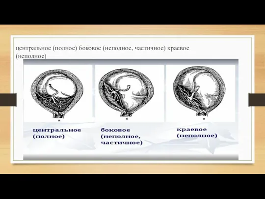 центральное (полное) боковое (неполное, частичное) краевое (неполное)