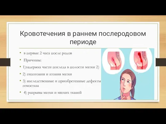 Кровотечения в раннем послеродовом периоде в первые 2 часа после родов