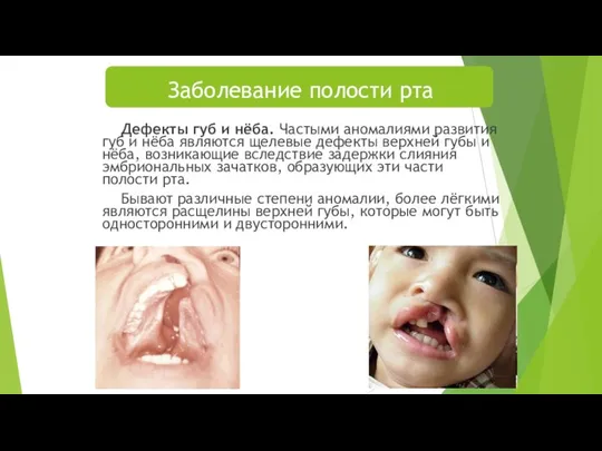 Заболевание полости рта Дефекты губ и нёба. Частыми аномалиями развития губ