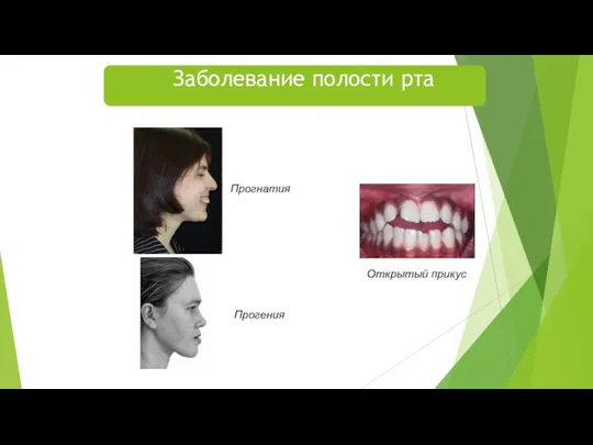 Прогнатия Прогения Открытый прикус Заболевание полости рта