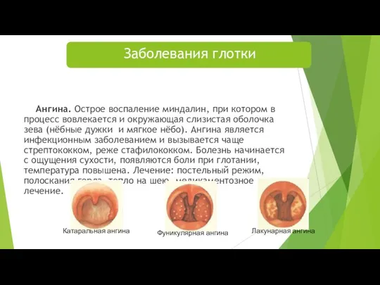 Ангина. Острое воспаление миндалин, при котором в процесс вовлекается и окружающая