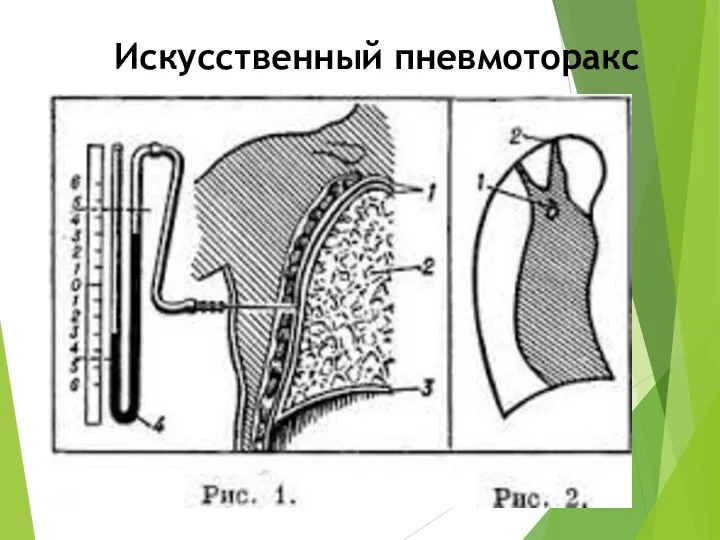 Искусственный пневмоторакс