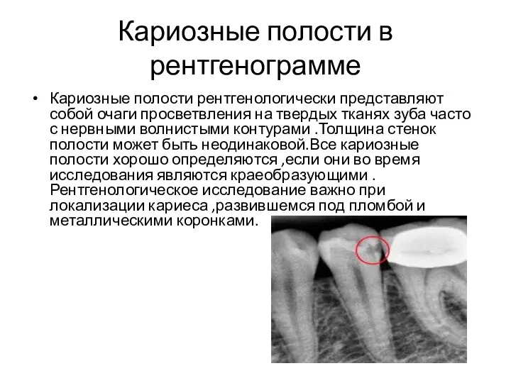 Кариозные полости в рентгенограмме Кариозные полости рентгенологически представляют собой очаги просветвления