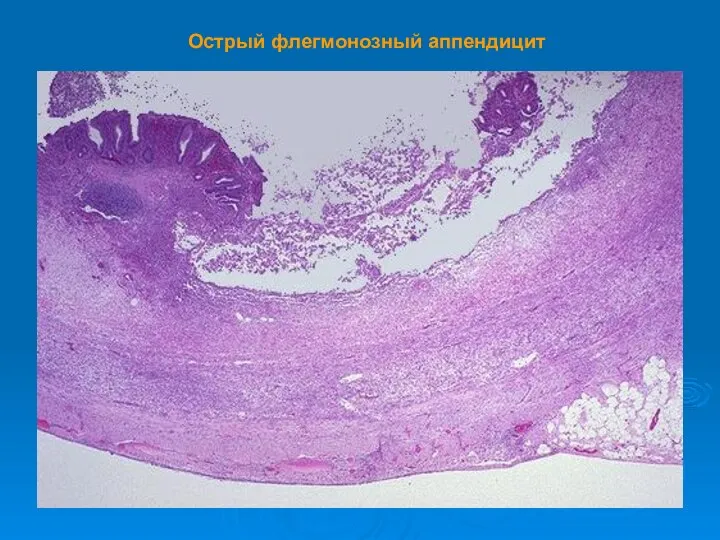 Острый флегмонозный аппендицит